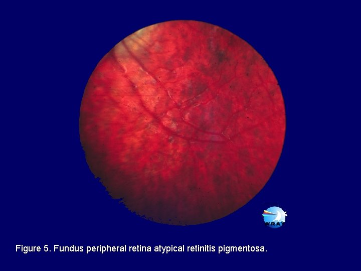 Figure 5. Fundus peripheral retina atypical retinitis pigmentosa. 