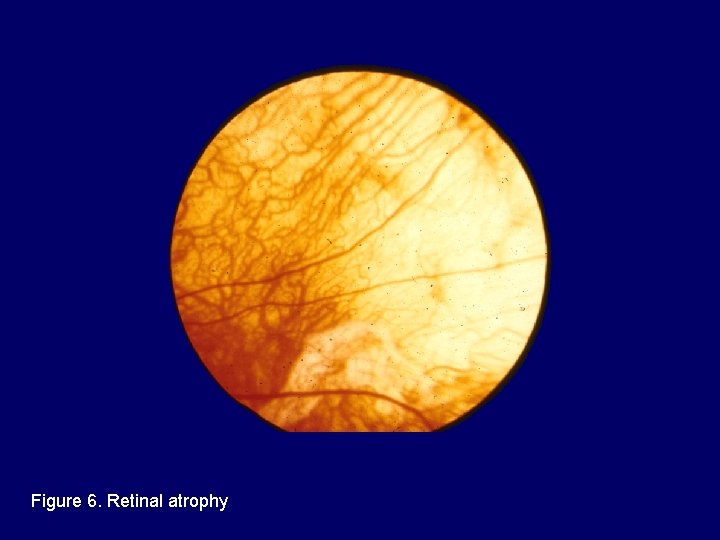 Figure 6. Retinal atrophy 