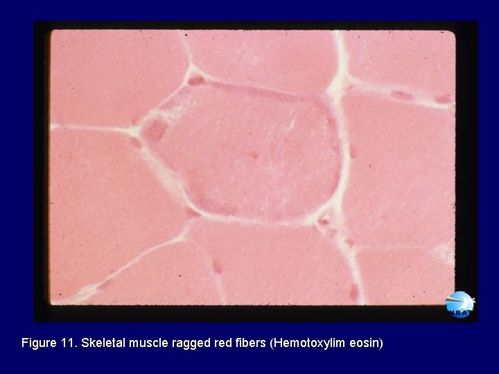 Figure 11. Skeletal muscle ragged red fibers (Hemotoxylim eosin) 