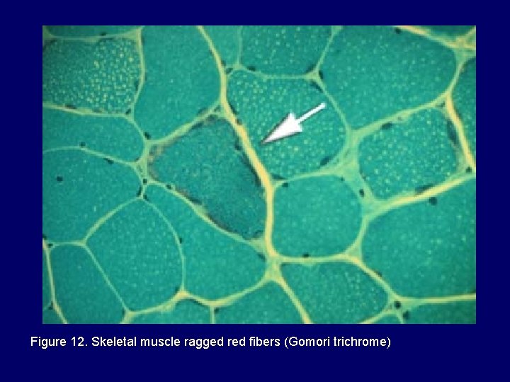 Figure 12. Skeletal muscle ragged red fibers (Gomori trichrome) Figure 12. Skeletal muscle ragged red fibers (Gomori trichrome)