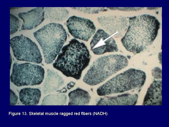 Figure 13. Skeletal muscle ragged red fibers (NADH) 