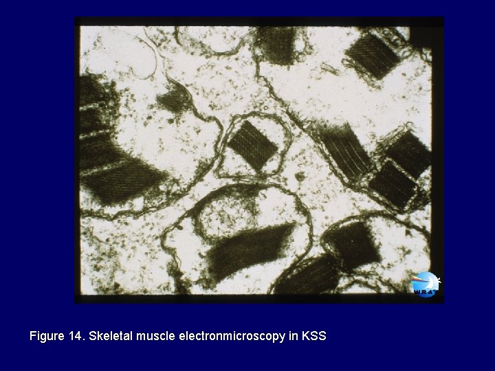 Figure 14. Skeletal muscle electronmicroscopy in KSS 