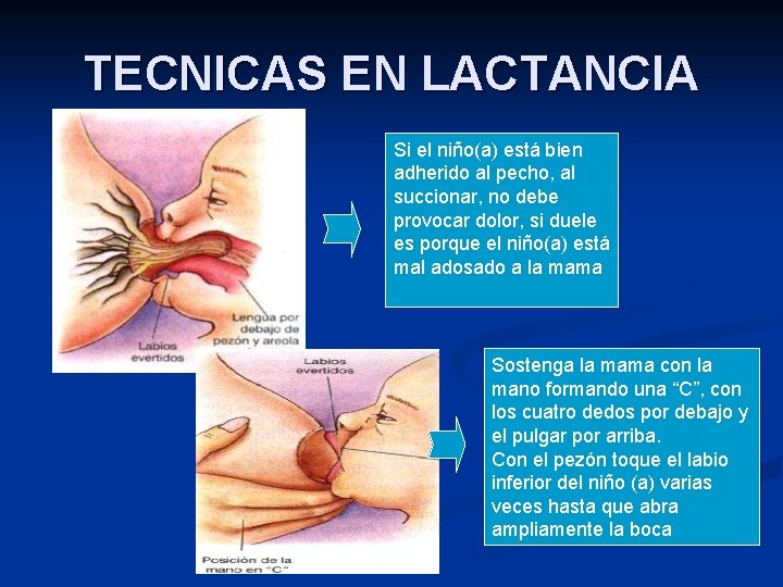 TECNICAS EN LACTANCIA Si el niño(a) está bien adherido al pecho, al succionar, no