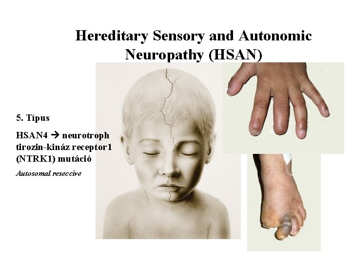 Hereditary Sensory and Autonomic Neuropathy (HSAN) 5. Típus HSAN 4 neurotroph tirozin-kináz receptor 1