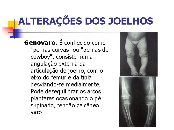 ALTERAÇÕES DOS JOELHOS Genovaro: É conhecido como "pernas curvas" ou "pernas de cowboy", consiste