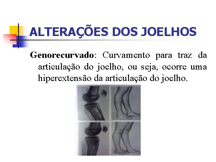 ALTERAÇÕES DOS JOELHOS Genorecurvado: Curvamento para traz da articulação do joelho, ou seja, ocorre