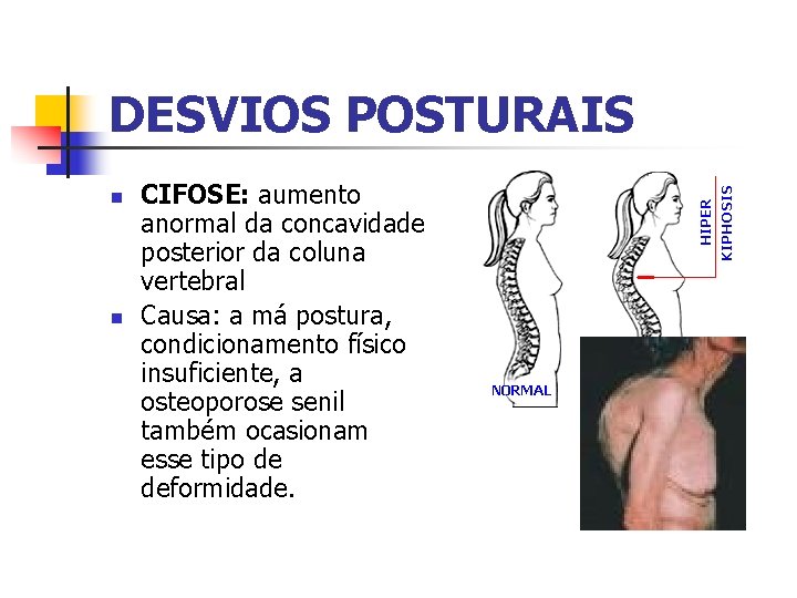 DESVIOS POSTURAIS n n CIFOSE: aumento anormal da concavidade posterior da coluna vertebral Causa: