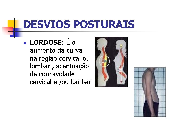 DESVIOS POSTURAIS n LORDOSE: É o aumento da curva na região cervical ou lombar