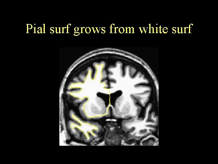 Pial surf grows from white surf 