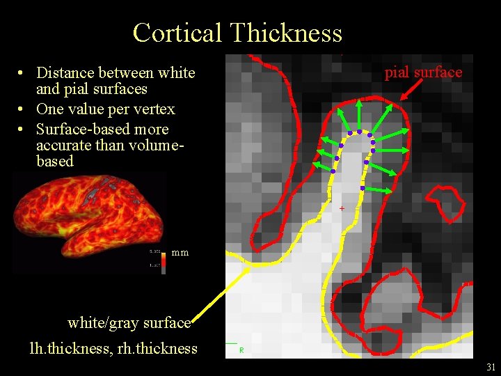 Cortical Thickness • Distance between white and pial surfaces • One value per vertex