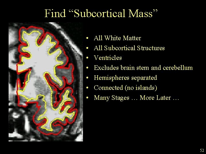 Find “Subcortical Mass” • • All White Matter All Subcortical Structures Ventricles Excludes brain