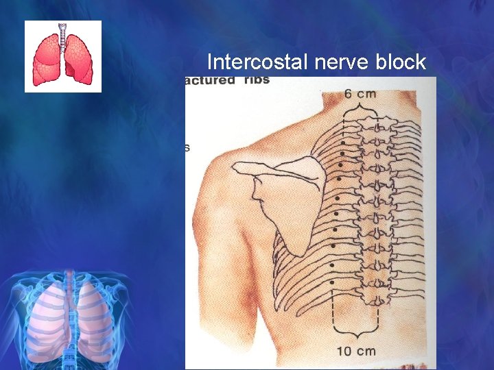 Intercostal nerve block 