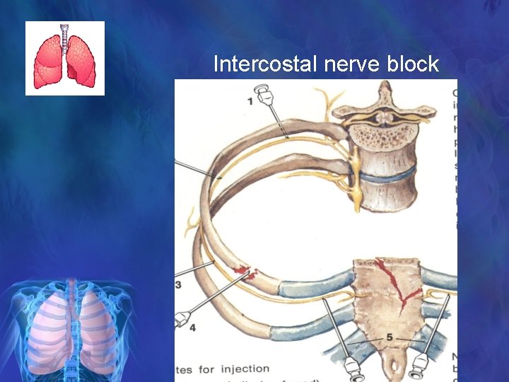Intercostal nerve block 