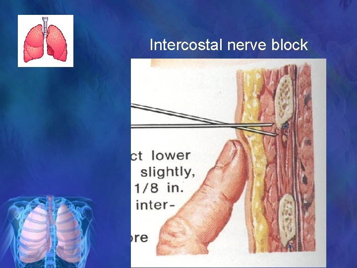 Intercostal nerve block 