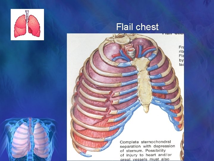 Flail chest 