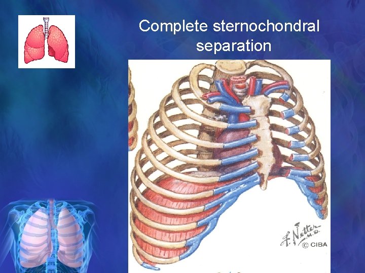 Complete sternochondral separation 