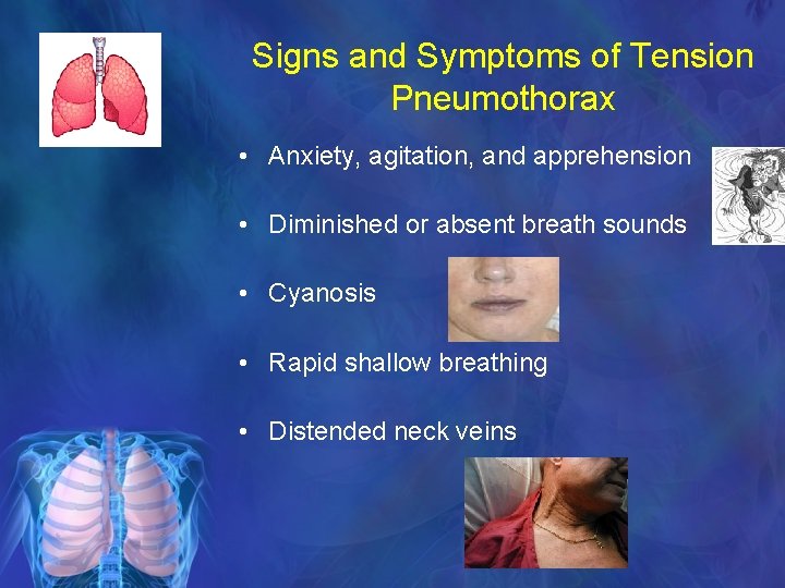 Signs and Symptoms of Tension Pneumothorax • Anxiety, agitation, and apprehension • Diminished or