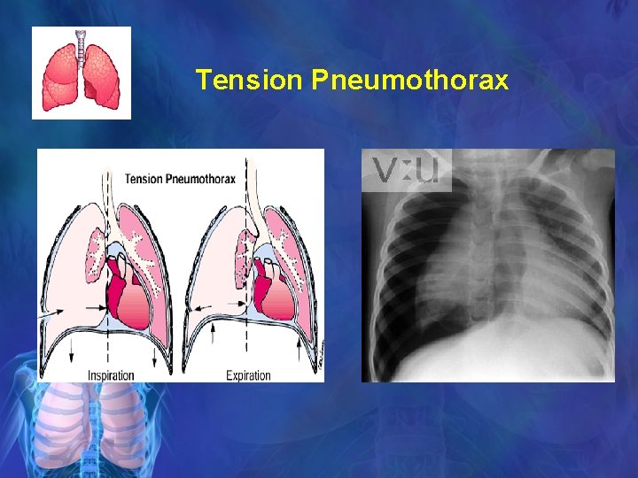 Tension Pneumothorax 