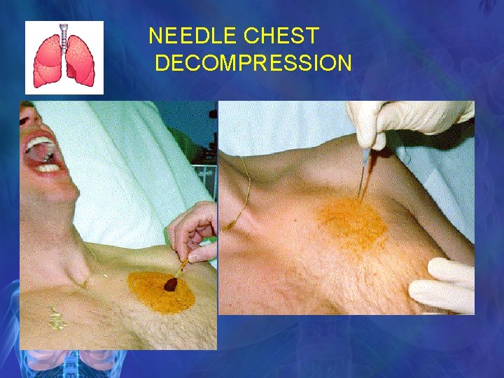 NEEDLE CHEST DECOMPRESSION 