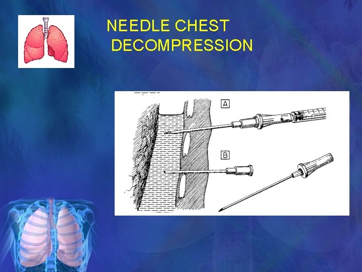 NEEDLE CHEST DECOMPRESSION 