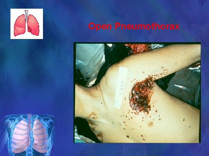 Open Pneumothorax 