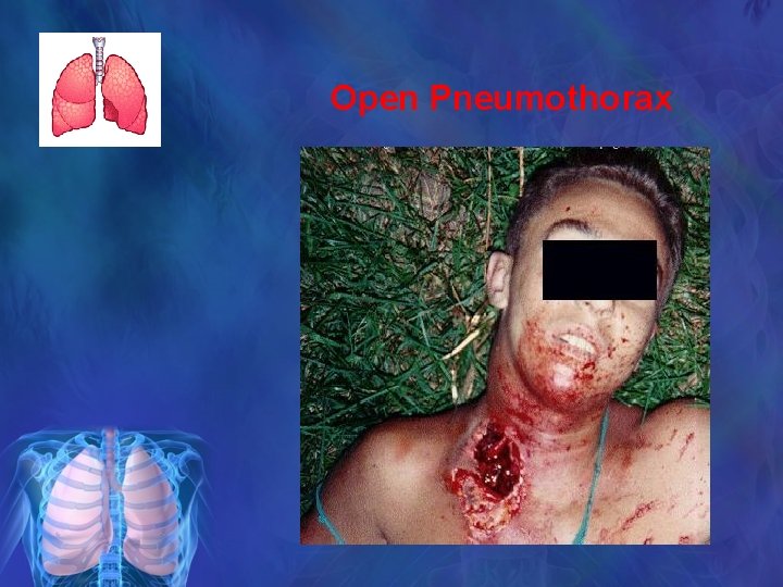 Open Pneumothorax 