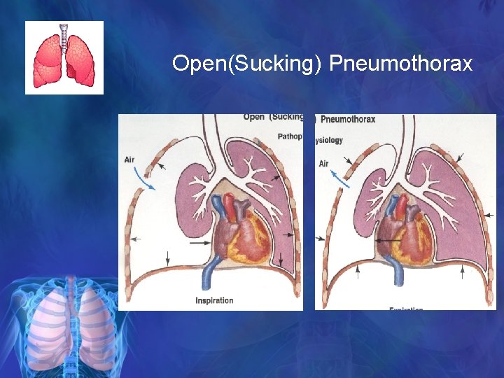 Open(Sucking) Pneumothorax 