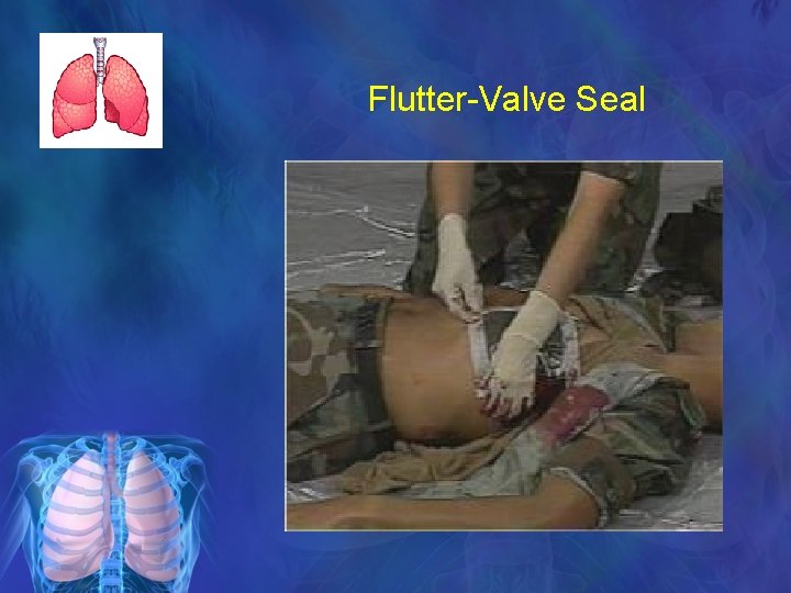 Flutter-Valve Seal 