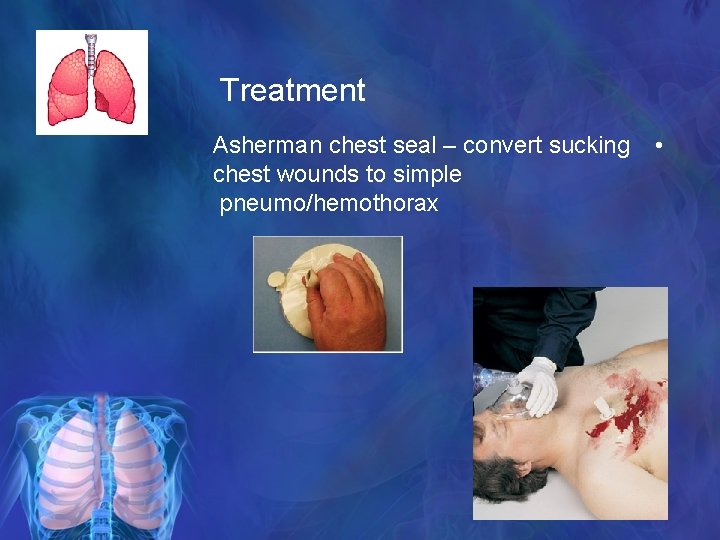 Treatment Asherman chest seal – convert sucking chest wounds to simple pneumo/hemothorax • 