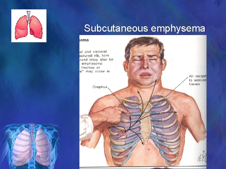 Subcutaneous emphysema 