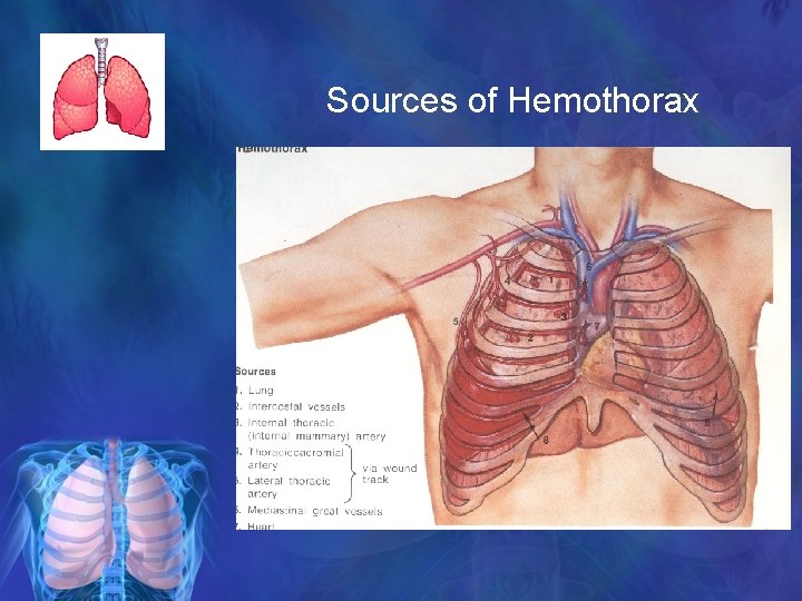 Sources of Hemothorax 