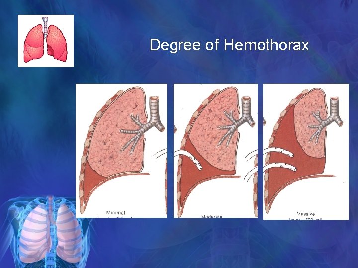 Degree of Hemothorax 