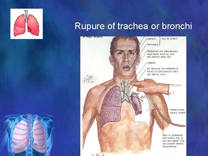 Rupure of trachea or bronchi 