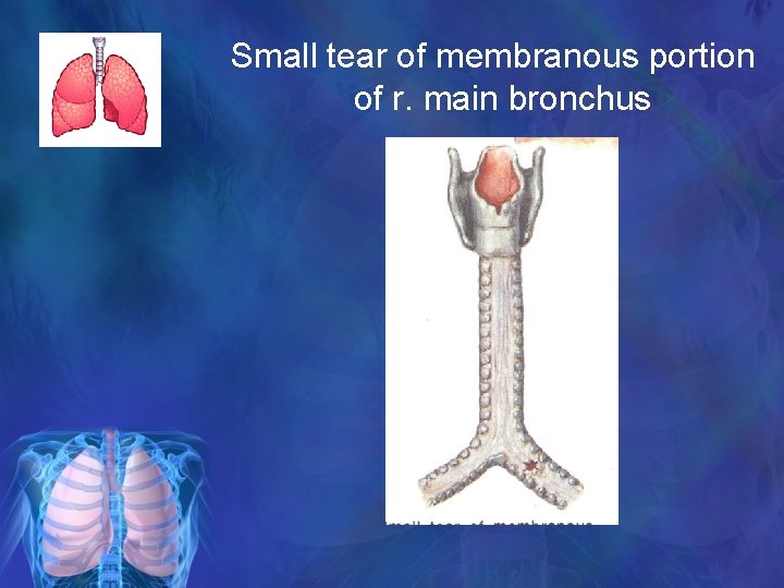 Small tear of membranous portion of r. main bronchus 
