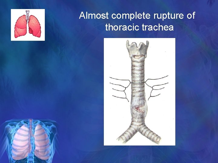 Almost complete rupture of thoracic trachea 