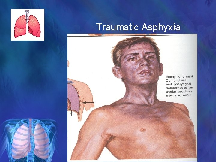 Traumatic Asphyxia 