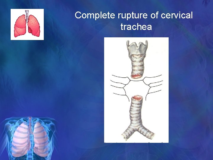 Complete rupture of cervical trachea 