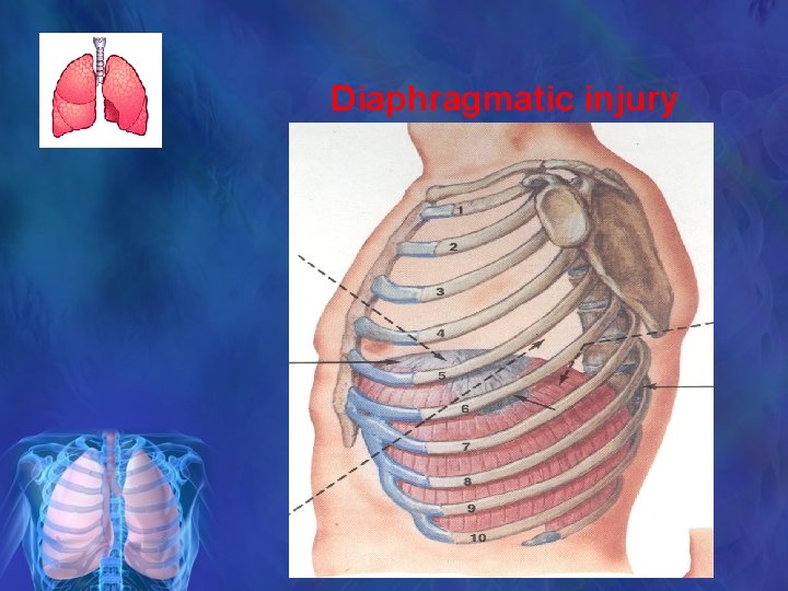 Diaphragmatic injury 