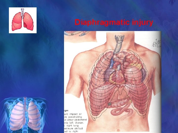 Diaphragmatic injury 