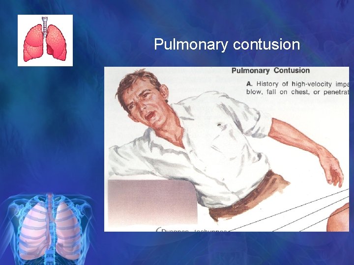 Pulmonary contusion 