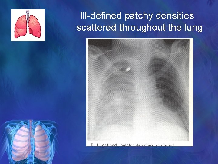 Ill-defined patchy densities scattered throughout the lung 