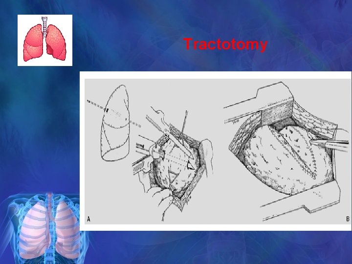 Tractotomy 