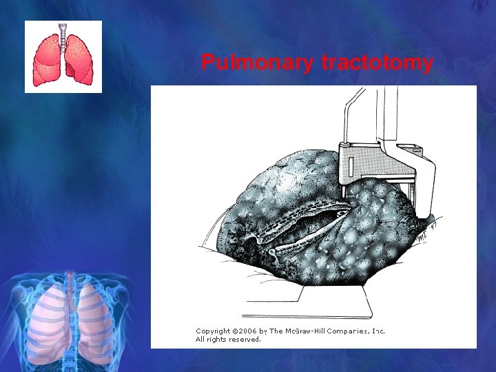 Pulmonary tractotomy 