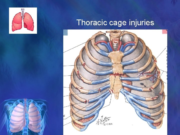 Thoracic cage injuries 