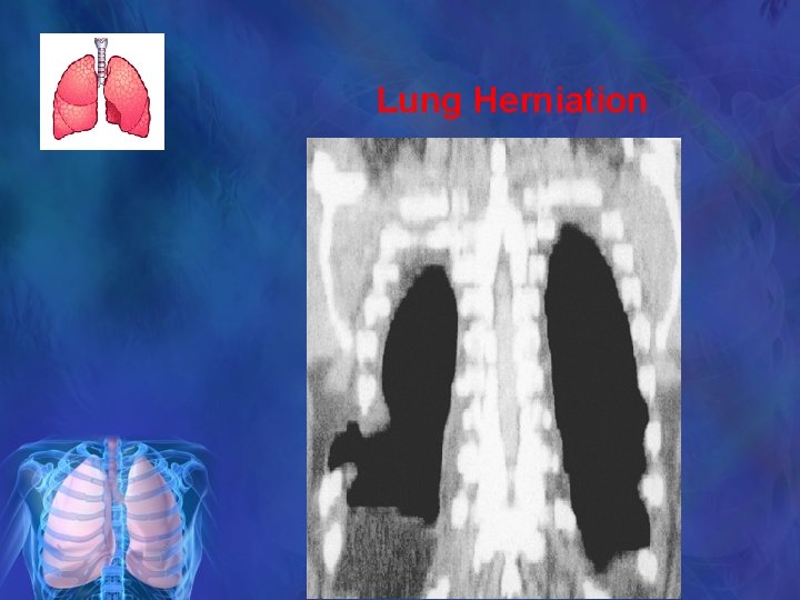 Lung Herniation 