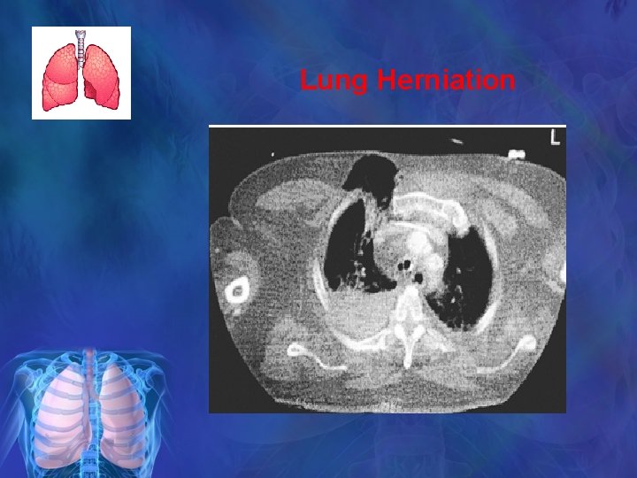 Lung Herniation 