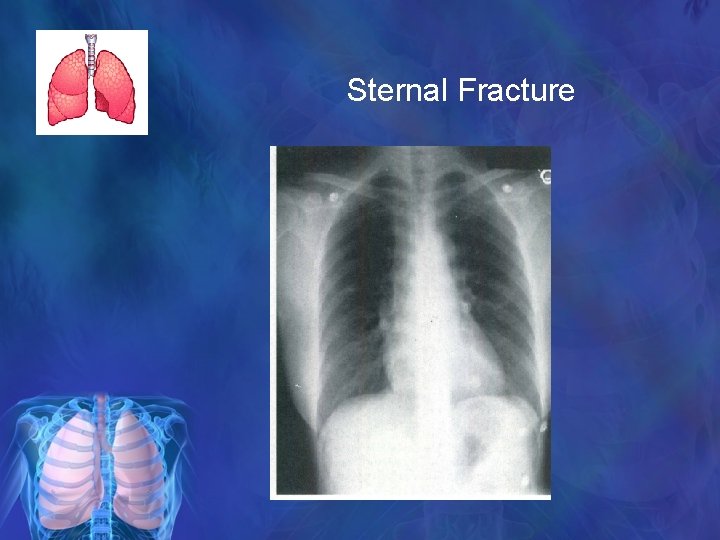 Sternal Fracture 