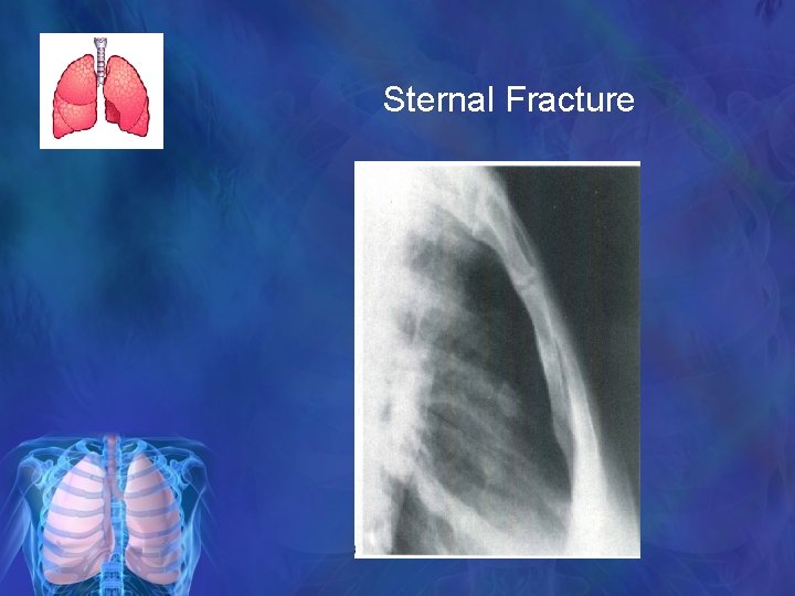 Sternal Fracture 