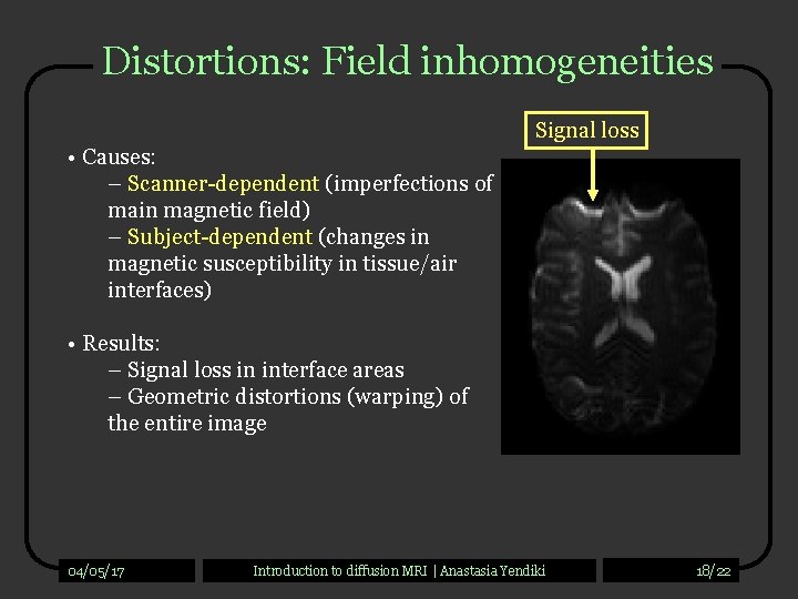 Distortions: Field inhomogeneities Signal loss • Causes: – Scanner-dependent (imperfections of main magnetic field)