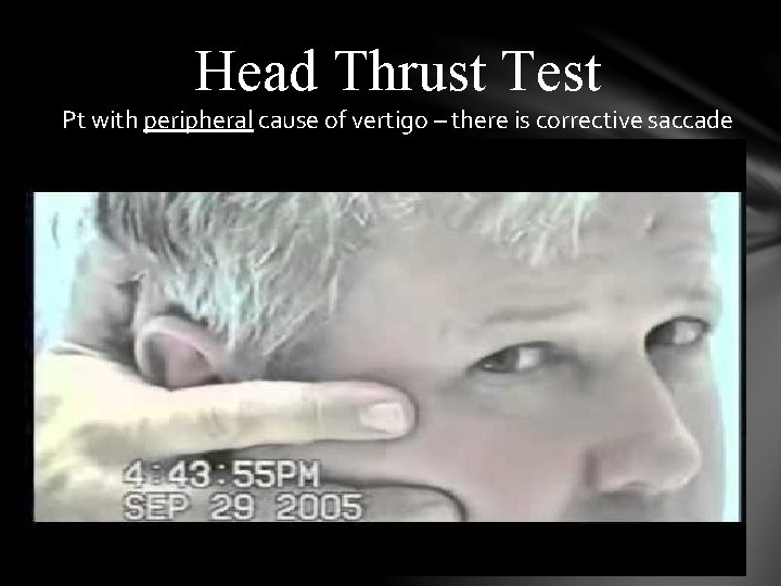 Head Thrust Test Pt with peripheral cause of vertigo – there is corrective saccade